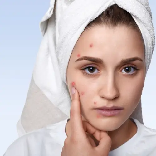 Acne and Acne Scar Treatments