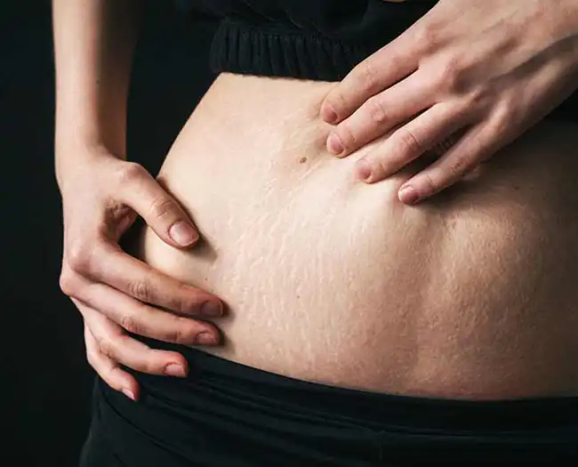 Stretch Marks